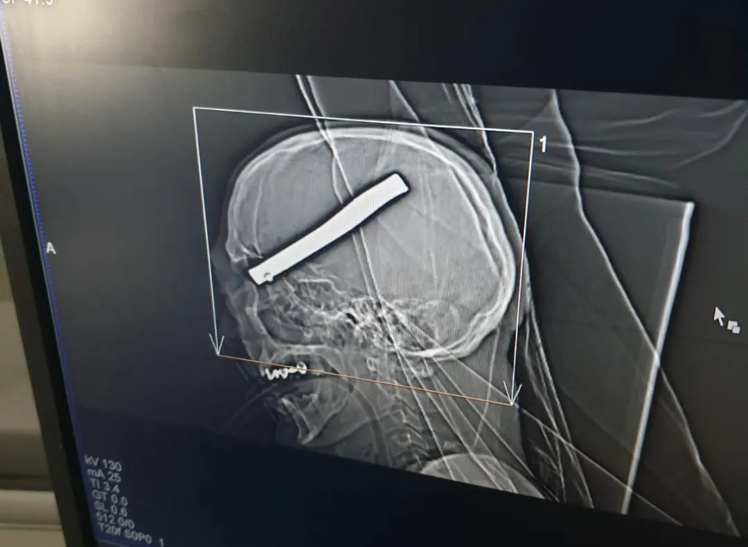 O tijă metalică de 20 de centimetri a rămas înfiptă în capul unui bărbat care repara o mașină