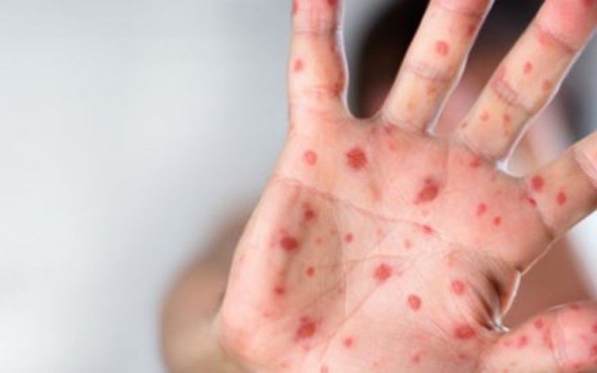 Bacăul rămâne pe lista județelor cu rujeolă în evoluție