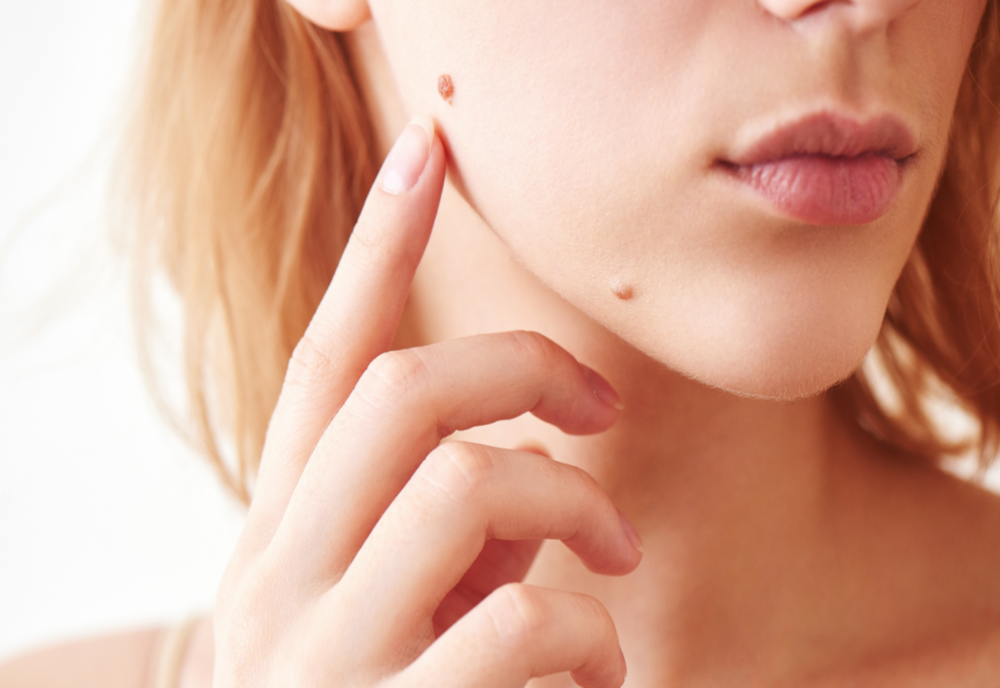 Alunițele. De ce apar și cum le recunoaștem pe cele periculoase pentru sănătate