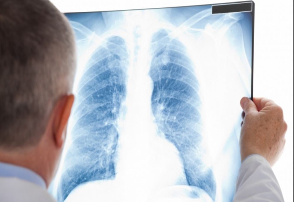 Crește alarmantă a numărul cazurilor de TUBERCULOZĂ la copii! Semnal de alarmă al medicilor: SIMPTOMELE care ar trebui să ne dea de gândit